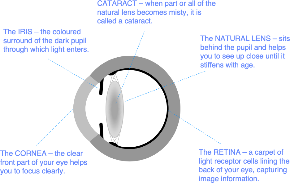 eye cataract without